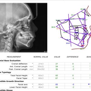 אנליזה לצילום צפלומטרי
